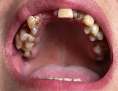 Ağzı kırık, dişleri hastalıklı. Caries ve periodontitis 'ten etkilenmiş. Diş kaplaması takmak için sakızda çelik çivi var. Nikotin plağıyla kaplanmış sigara içen birinin dişleri..