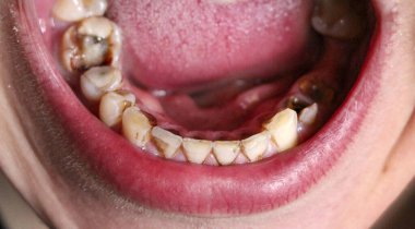 Ağzı kırık, dişleri hastalıklı. Caries ve periodontitis 'ten etkilenmiş. Diş kaplaması takmak için sakızda çelik çivi var. Nikotin plağıyla kaplanmış sigara içen birinin dişleri..