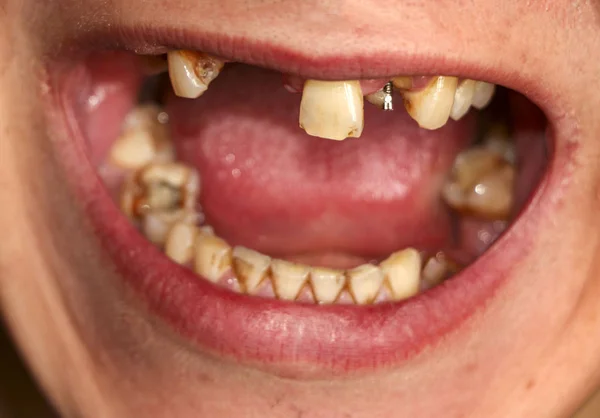 Open mond met gebroken, zieke tanden aangetast door cariës en parodontitis. Stalen pin in het tandvlees voor de installatie van een tandartskroon. Rooktanden bekleed met nicotine plaque. — Stockfoto