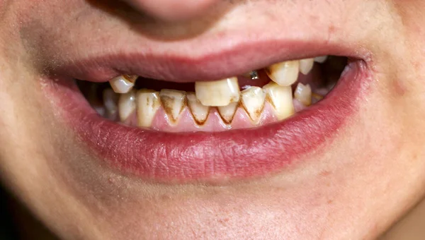 Open mouth with broken, diseased teeth affected by caries and periodontitis. Steel pin in the gum for the installation of a dental crown. Smoker's teeth coated with nicotine plaque. — Stock Photo, Image