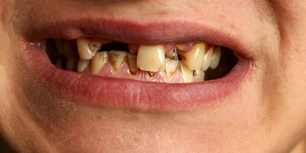 Open mouth with broken, diseased teeth affected by caries and periodontitis. Steel pin in the gum for the installation of a dental crown. Smoker's teeth coated with nicotine plaque. — Stock Photo, Image
