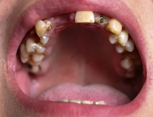 Nyitott száj törött, beteg fogak által érintett fogszuvasodás és periodontitis. Acél kitűző a rágógumiban egy fogászati korona elhelyezéséhez. Füstölőfog nikotintartalommal bevonva. — Stock Fotó