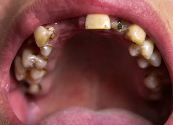 Nyitott száj törött, beteg fogak által érintett fogszuvasodás és periodontitis. Acél kitűző a rágógumiban egy fogászati korona elhelyezéséhez. Füstölőfog nikotintartalommal bevonva. — Stock Fotó