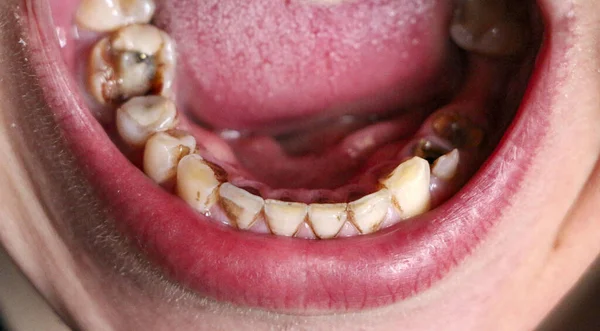 Ανοιχτό στόμα με σπασμένα, άρρωστα δόντια που επηρεάζονται από τερηδόνα και περιοδοντίτιδα. Ατσάλινη περόνη στην τσίχλα για την τοποθέτηση οδοντικής στεφάνης. Δόντια καπνιστή επικαλυμμένα με πλάκα νικοτίνης. — Φωτογραφία Αρχείου