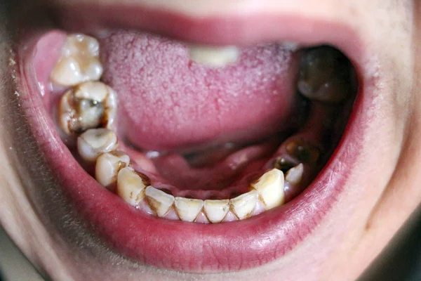 Open mouth with broken, diseased teeth affected by caries and periodontitis. Steel pin in the gum for the installation of a dental crown. Smoker's teeth coated with nicotine plaque. — Stock Photo, Image