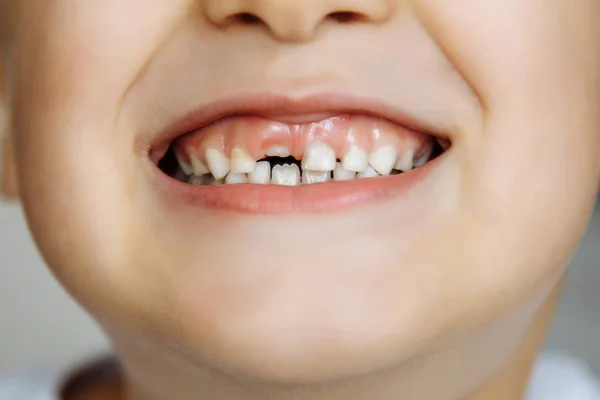 Fechar-se de uma criança sorridente sem dentes — Fotografia de Stock