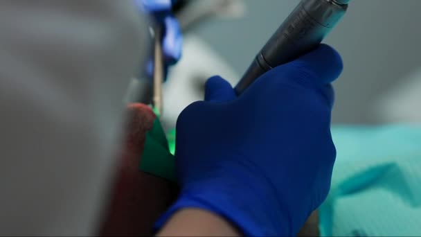 Zahnarzt und Krankenschwester reparieren einen Zahn eines Patienten. die Verwendung von Bormaschenko, um Zähne zu bohren und Karies und Versiegelung zu entfernen. — Stockvideo