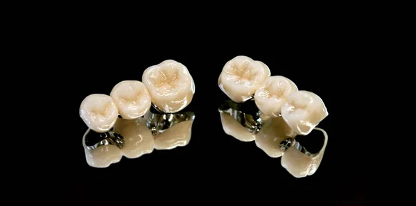 Kovové keramické zubní protézy — Stock fotografie