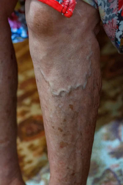 Primer Plano Pies Anciano Que Sufre Lepra Con Bastón Suelo — Foto de Stock