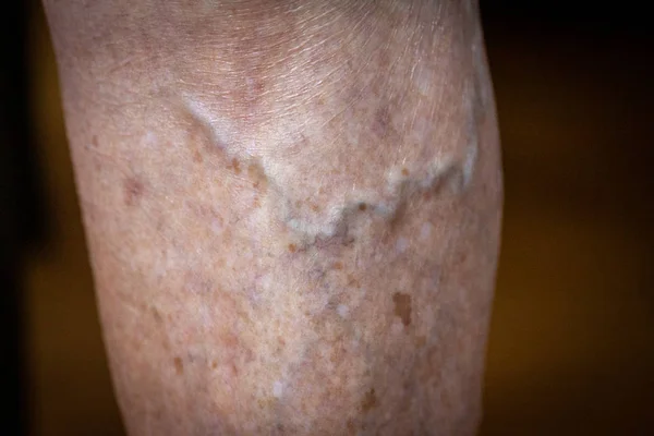 Closeup Feet Old Man Suffering Leprosy Cane Ground — ストック写真