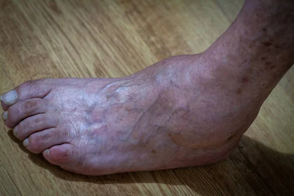 closeup feet of old man suffering from leprosy with a cane on the ground