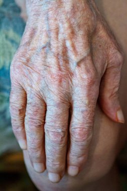 İnsan derisinin yaşlanma süreci - çok yaşlı bir adamın kırışık elleri 90-100 yıl boyunca kuru cilt ve lekelerle kaplı yaşadı.