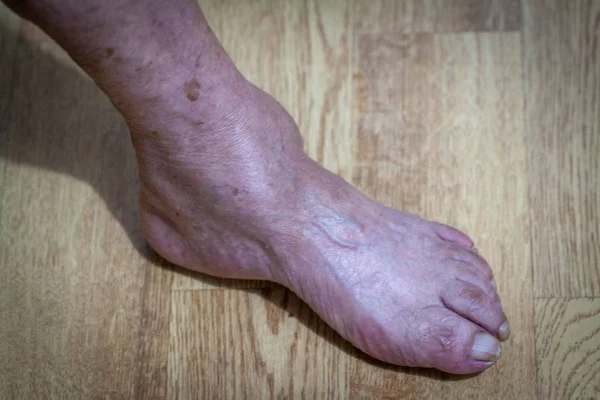 closeup feet of old man suffering from leprosy with a cane on the ground