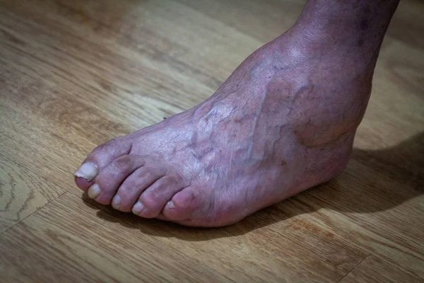 Большие ноги издревле страдают от проказы — стоковое фото