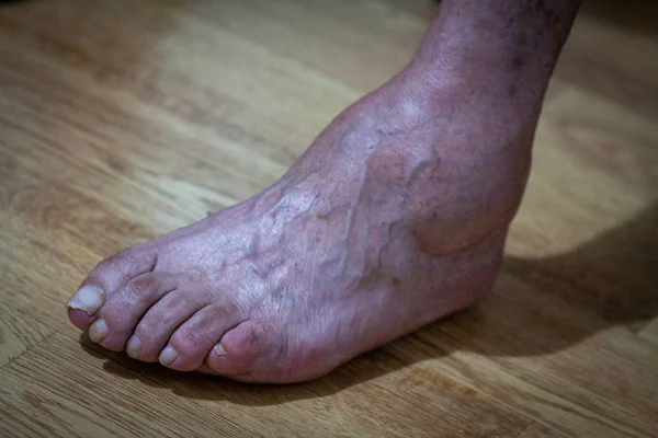 closeup feet of old an suffering from leprosy