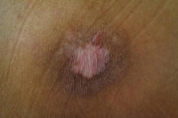 Terrible wounds pressure sore — Stock Photo, Image