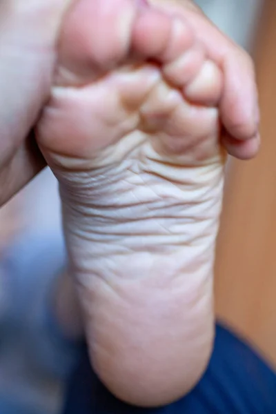 새끼 발가락은 건강하고 아름다워요. — 스톡 사진