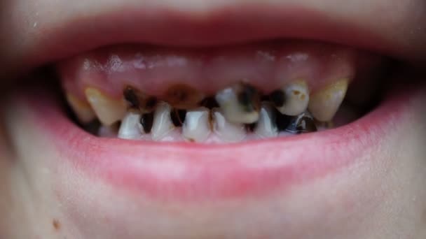 Caries de imágenes en los dientes del niño de cerca . — Vídeos de Stock