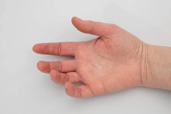 Very Dry Skin Womans Hand Gray Background — Stock Photo, Image