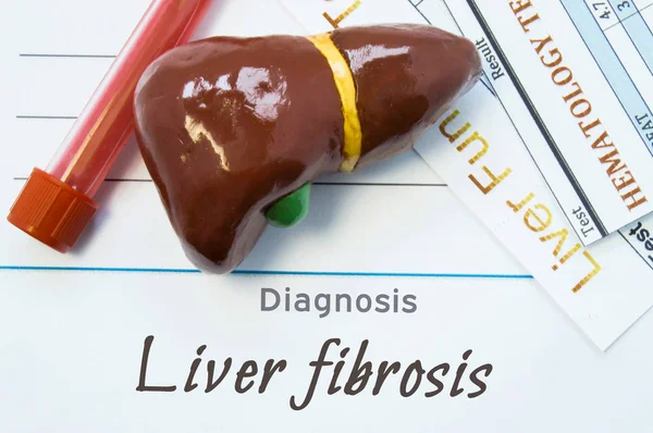 Diagnostic de fibrose hépatique. Feuille de papier ou livre avec inscription La fibrose hépatique se trouve à côté du stéthoscope, du modèle du foie humain et de deux tests de laboratoire : test sanguin commun et analyse des fonctions hépatiques — Photo