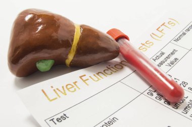 Figure of human liver, laboratory test tube or bottle with blood and paper result of liver function or enzyme test (LFTs) analysis are on doctor table. Concept to represent liver function test or exam clipart