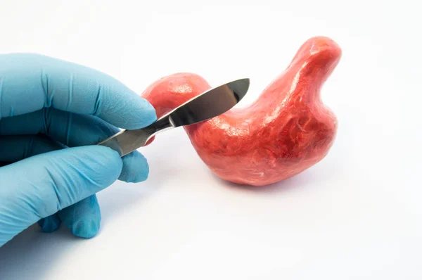 Concept of gastric surgery. Surgeon holding scalpel near anatomical model of stomach. Surgery operations and treatment of diseases of stomach same as ulcer, cancer, removal, reflux, bypass or sleeve