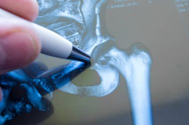 Kalça eklemi X-Ray. Doktor nerede patoloji, kırık gibi ortak, coxarthrosis, osteoartrit imha algılanır alanda Kalça eklemi, işaret etti. Radyoloji tarafından ortak hastalıkların