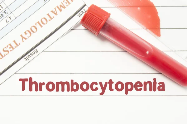 Tanı trombositopeni. Notepad metni ile trombositopeni, laboratuvar test tüpleri için kan, Kan yayması mikroskobu ve doktor masada kan laboratuvar testinin sonuçları için etiketleri — Stok fotoğraf