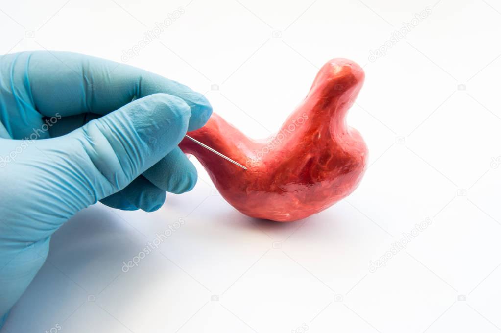  Concept of stomach puncture or gastrointestinal perforation. Hand of surgeon pierces wall of model of human stomach for therapeutic purposes or for biopsy tissue analysis by histology or cytology
