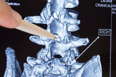 Doktor gösterir Ct MRI üzerinde omurga prosedür epidural anestezi veya spinal ponksiyon kuralları omurga arasında bir yerde inceden inceye gözden geçirmek. Epidural anestezi doğum sırasında veya Nöroşirürji operasyonları sırasında 