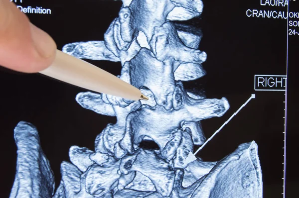 Dokter shows op Ct Mri scans plaats in de wervelkolom tussen de wervels, die procedure voor epidurale anesthesie of spinale punctie gedrag. Epidurale verdoving tijdens de bevalling of neurochirurgische behandelingen — Stockfoto