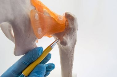 Boyun uyluk (kalça) - uyluk kemiği konsept fotoğraf sık kırık bir yer. Ortopedi doktoru boyun femur kemik - özellikle de yaşlı insanların çoğu kez kalça kırığı alanı gösterir