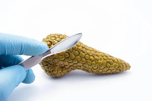 Médecin se préparant à couper avec le scalpel figure de la glande pancréatique sur fond blanc. Concept photo d'interventions chirurgicales médicales et traitement chirurgical du pancréas et de la zone anatomique hépatobiliaire — Photo