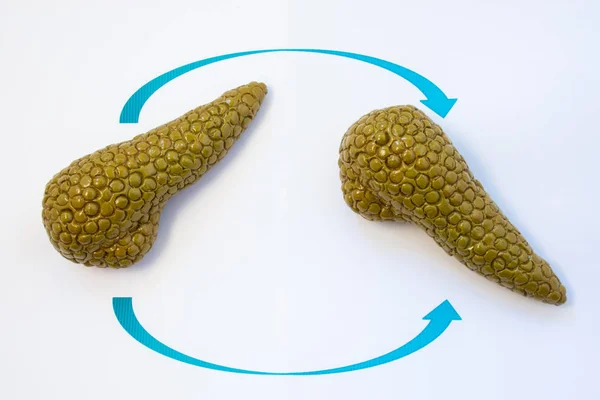 Foto del concepto de trasplante de páncreas. Dos modelos anatómicos de glándula páncreas con dos flechas cruzándose entre sí, simbolizando el proceso de trasplante u operación del órgano humano —  Fotos de Stock