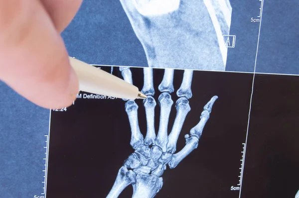 Radiografía de la mano, los huesos y las articulaciones de los dedos. El médico señaló las articulaciones pequeñas del dedo, donde se detecta patología, como artritis, reumatoide, fractura. Diagnóstico de enfermedades articulares por radiología —  Fotos de Stock