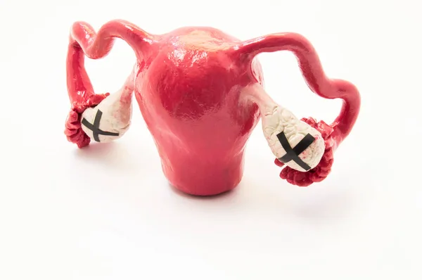 Oophorectomy or surgical removal of ovary or ovaries concept. Anatomical pictorial figure female genitals with black crosses ovarian symbolizes removal of ovary operation spaying or severe dysfunction — Stock Photo, Image