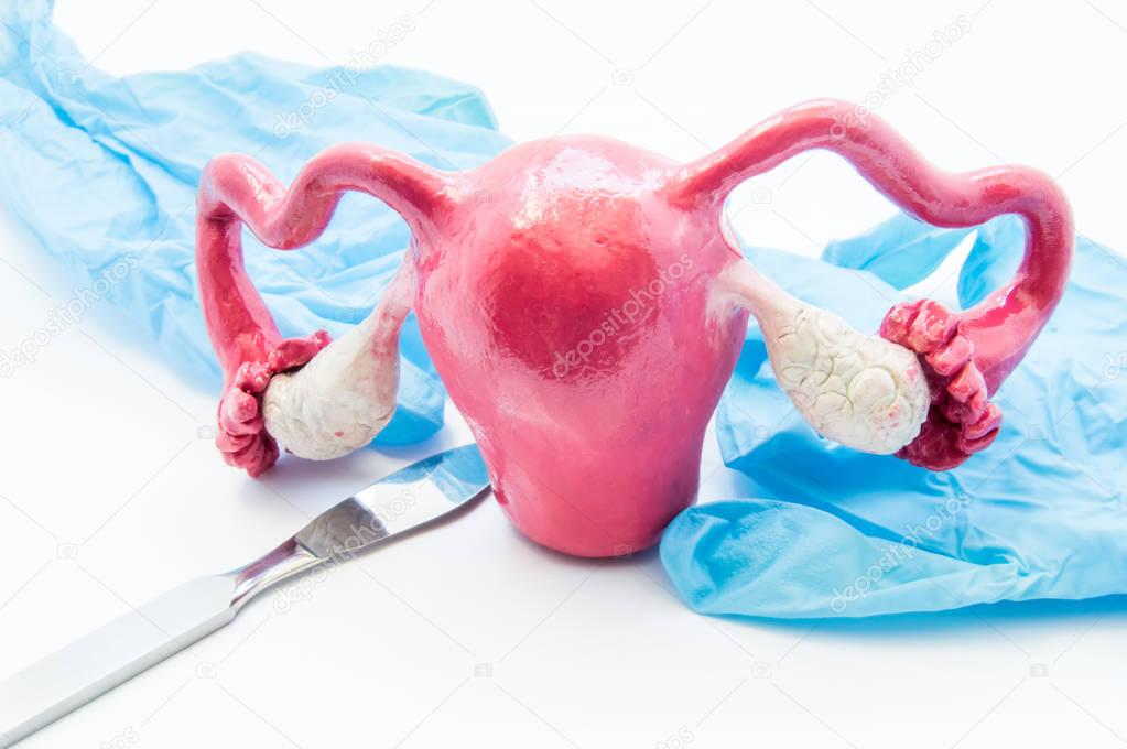 Concept of gynecology surgery. 3D model of female uterus is near scalpel and medical gloves. Surgery in gynecology and operation on uterus, ovaries or fallopian tubes such hysterectomy or myomectomy 