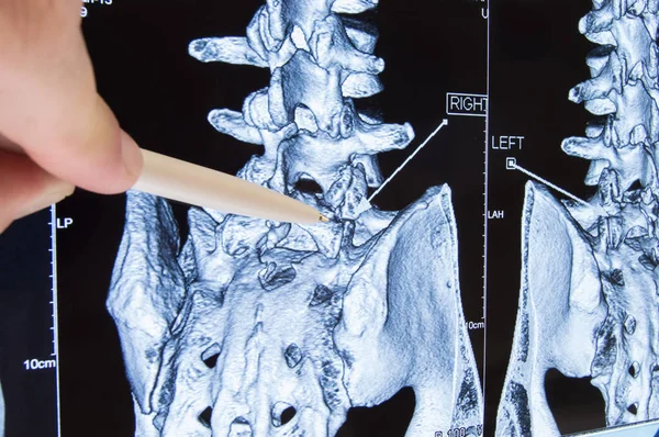Scan of lumbosacral spine. Doctor pointed on area of lumbar, where pathology is detected, such as radiculitis, radiculopathy, hernia, low back pain. Diagnosis of spine diseases by radiology — Stock Image Scan of lumbosacral spine. Doctor pointed on area of lumbar, where pathology is detected, such as radiculitis, radiculopathy, hernia, low back pain. Diagnosis of spine diseases by radiology Stock Photo