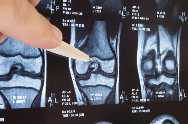 Kniegelenk röntgen oder mri. Arzt zeigte auf Bereich des Kniegelenks, wo Pathologie oder Problem erkannt wird, wie Fraktur, Zerstörung des Gelenks, Arthrose. Diagnose von Knieerkrankungen durch Radiologie — Stockfoto