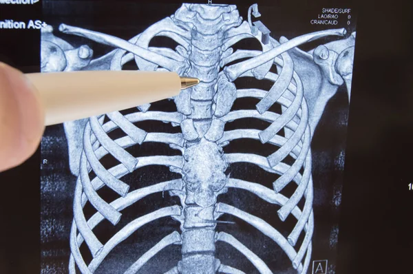 胸椎 Mri または Ct x 線イメージ。医者は、胸椎骨軟骨症や他の病気にローカライズされてしばしば患者の脊椎胸部 x 線画像を指す — ストック写真