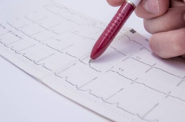 Ofiste doktor hasta ile beyaz bir tıbbi masada yatıyor Elektrokardiyogram (EKG, Ekg), algılanan patoloji kesimindeki bir tükenmez kalem kullanarak gösterir. Kardiyak patoloji kavramı