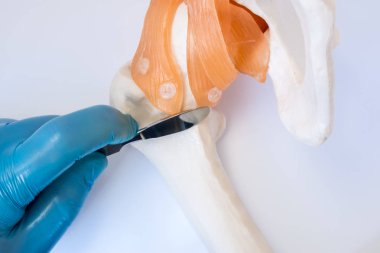Ortopedik veya travma cerrahisi konsept fotoğraf. Cerrah cerrahi neşteri elinde, torpido gözünde, uyluk kemiği Kalça eklemi, yakınındaki üzerine giymiş kemik ve eklem ortopedik cerrahi operasyon simgeleyen tutar