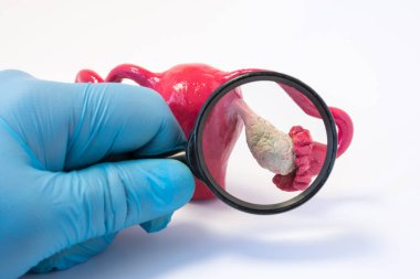 Arama hastalığı, anormallikler veya yumurtalık konsept fotoğraf patolojisi. Holding doktor büyütme cam ve yumurtalıklar, teşhis için hastalık kanser, felç, kist, Pos gibi iletken modelini inceliyor