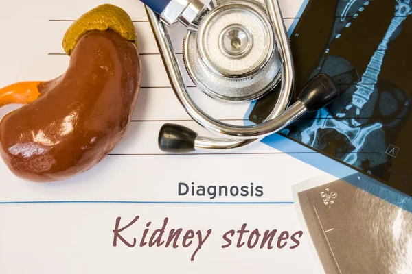 Diagnosis Kidney Stones photo. Figure of kidney lies next to inscription of diagnosis of kidney stones, ultrasound and MRI test result and stethoscope. Idea of diagnosing of disease nephrolithiasis