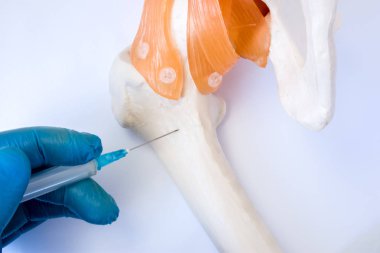 Kemik iliği sınav prosedürü: biyopsi, aspirasyon veya Parasentez konsept fotoğraf. Doktor tutar elinde eldiven şırıngada giyinmiş iğne ve kemik iliği analizini almaya kalça kemik modelinin ponksiyon