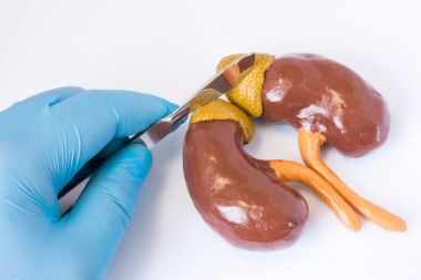 Böbrek üstü bezi cerrahi konsept fotoğraf. 3D anatomik şekli, böbrek üstü bezi ve böbrekler cerrah yanında neşter tutan mavi eldiven ver. Cerrahi operasyon kanser, tümör, sebepleri, adenoma