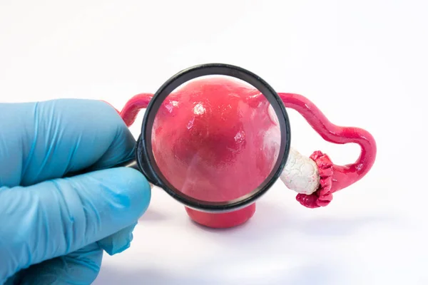 搜索疾病 子宫或子宫的病理异常或病变的概念照片 医生拿着放大镜 通过它检查子宫 子宫或卵巢的模型 对疾病进行诊断 — 图库照片