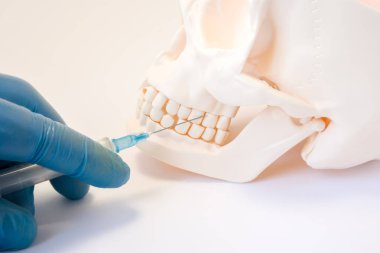 Diş anestezi veya delinme kist diş konsept fotoğraf. Şırınga, kafatası dişleri üzerinde üst çene içine iğne saplar tutan doktor dişçi diş anestezi prosedürü, kist ponksiyon takip