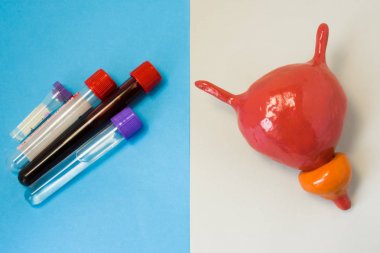 Laboratuvar tanısında metabolik fonksiyon, hasar prostat ve mesane hastalıkları, biyokimyasal ihlal. Prostat ve laboratuvar test tüpleri yalan üzerine gri ve mavi arka plan ile mesane