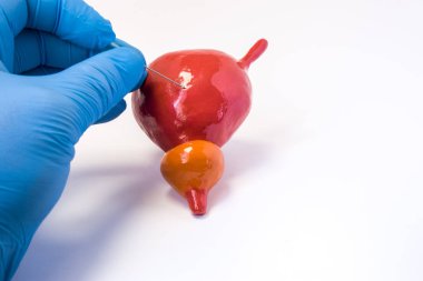 İdrar kesesi SUPRAPUBIK ponksiyon biyopsi veya sistoskopi yordamı. Holding ürolog iğne ve vücut ponksiyon yapar anatomik idrar mesane. Üroloji veya hastalıkların tanı yordamı